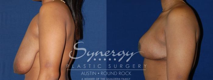 Before & After Breast Reduction Case 131 View #2 View in Austin, TX