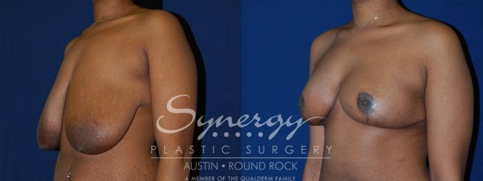 Before & After Breast Reduction Case 131 View #3 View in Austin, TX