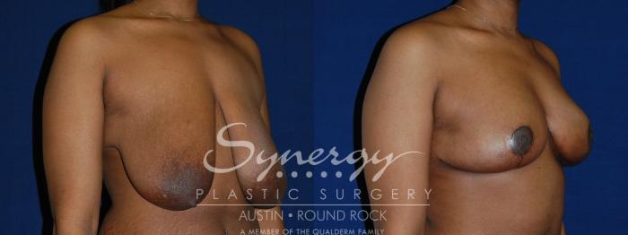 Before & After Breast Reduction Case 131 View #4 View in Austin, TX