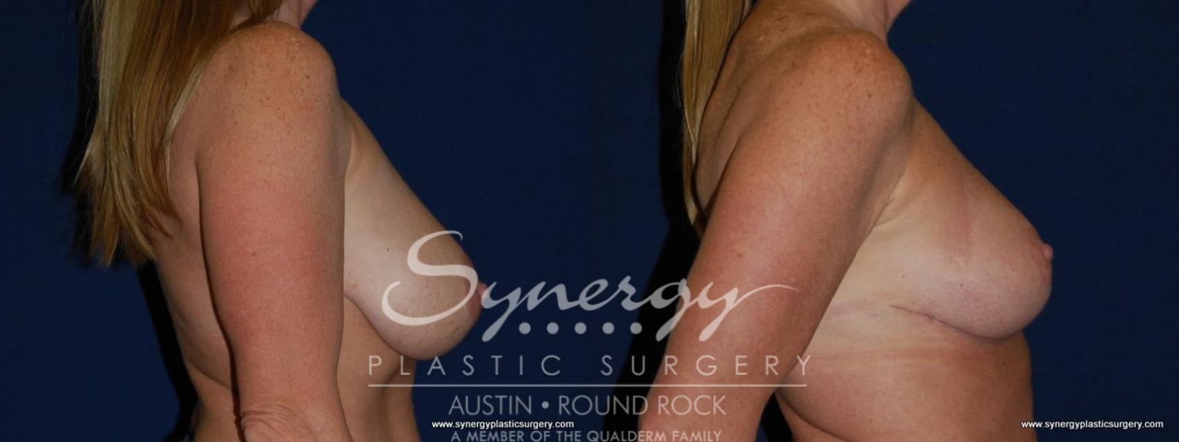 Before & After Breast Reduction Case 146 View #1 View in Round Rock, TX