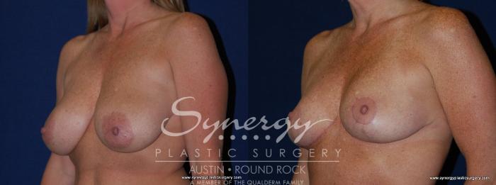 Before & After Breast Reduction Case 146 View #2 View in Austin, TX