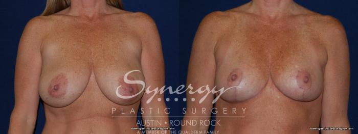 Before & After Breast Reduction Case 146 View #3 View in Austin, TX