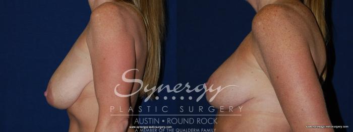 Before & After Breast Reduction Case 146 View #4 View in Austin, TX