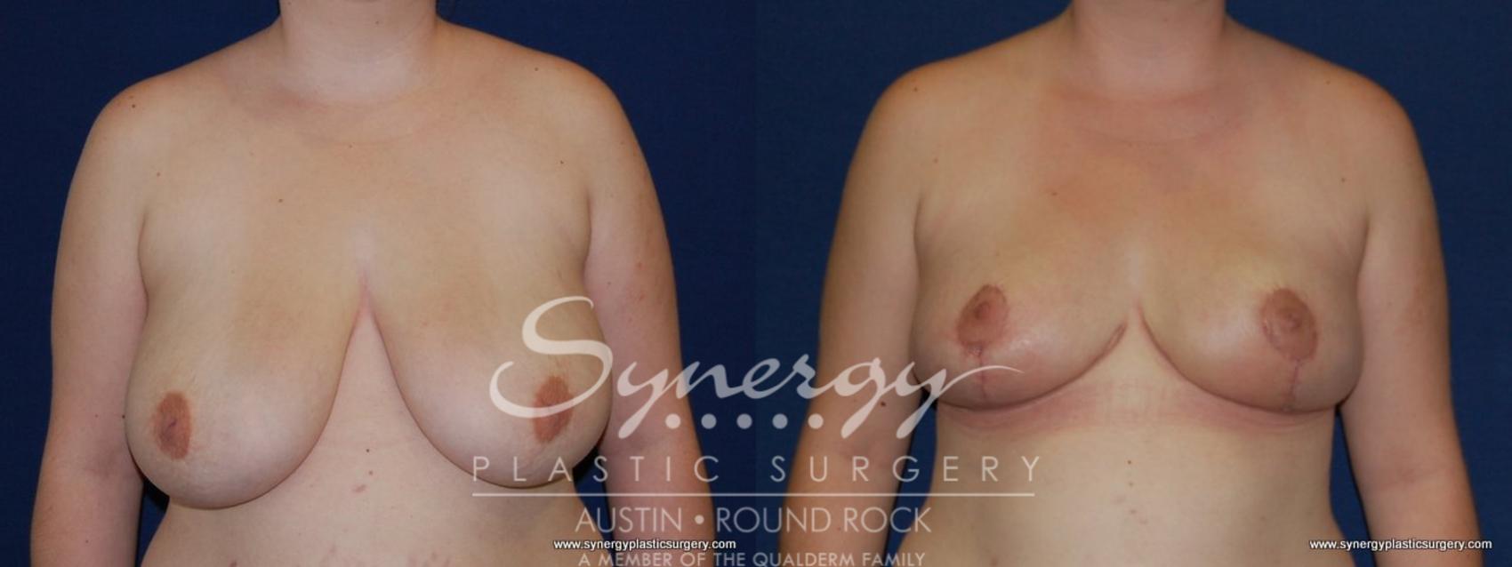 Before & After Breast Reduction Case 164 View #1 View in Austin, TX