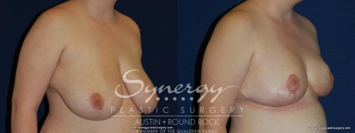 Before & After Breast Reduction Case 164 View #2 View in Austin, TX