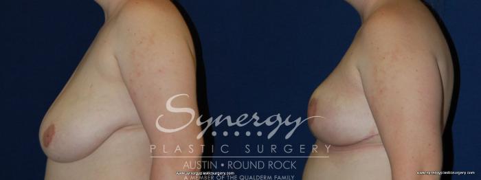 Before & After Breast Reduction Case 164 View #3 View in Austin, TX