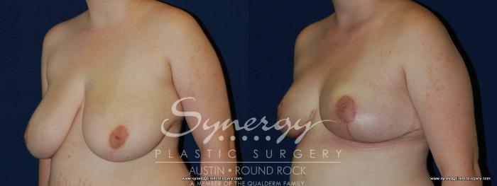 Before & After Breast Reduction Case 164 View #4 View in Austin, TX