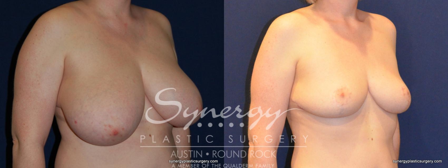 Before & After Breast Reduction Case 208 View #1 View in Round Rock, TX