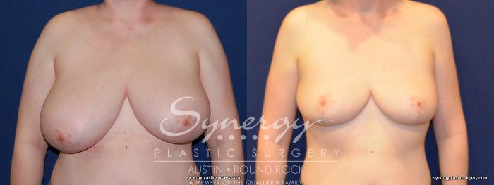 Before & After Breast Reduction Case 208 View #2 View in Austin, TX