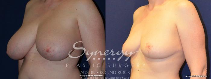 Before & After Breast Reduction Case 208 View #3 View in Austin, TX