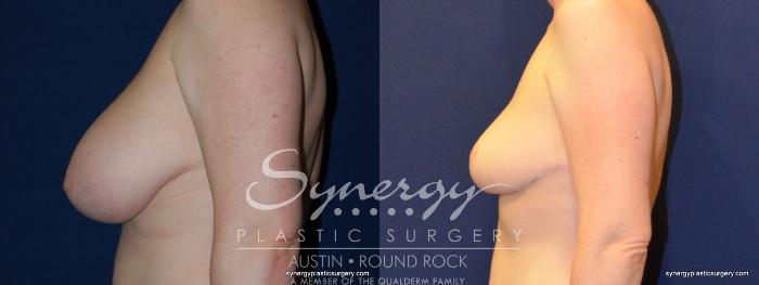 Before & After Breast Reduction Case 208 View #4 View in Austin, TX