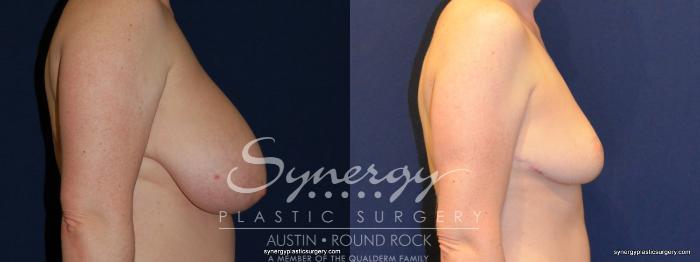 Before & After Breast Reduction Case 208 View #5 View in Austin, TX
