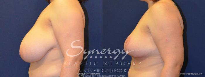 Before & After Breast Reduction Case 231 View #2 View in Austin, TX