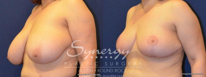 Before & After Breast Reduction Case 231 View #3 View in Austin, TX