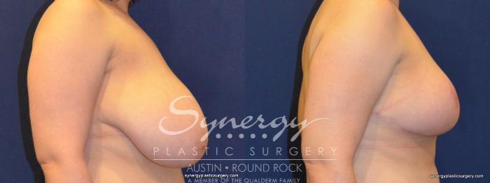 Before & After Breast Reduction Case 231 View #4 View in Austin, TX
