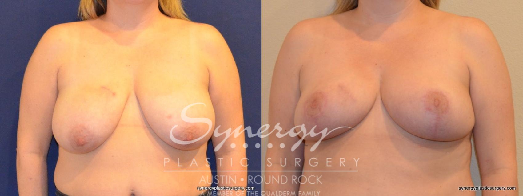 Before & After Breast Reduction Case 268 View #1 View in Austin, TX