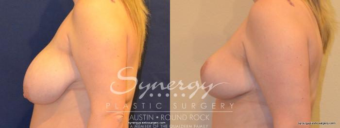Before & After Breast Reduction Case 268 View #2 View in Austin, TX