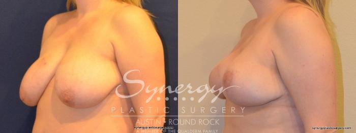 Before & After Breast Reduction Case 268 View #3 View in Austin, TX