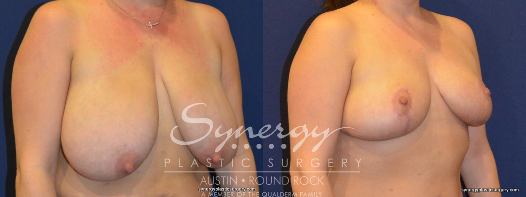 Before & After Breast Reduction Case 271 View #1 View in Austin, TX