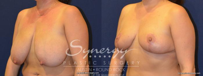 Before & After Breast Reduction Case 271 View #2 View in Austin, TX