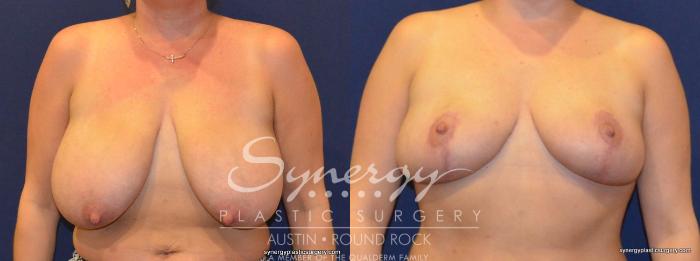 Before & After Breast Reduction Case 271 View #3 View in Austin, TX