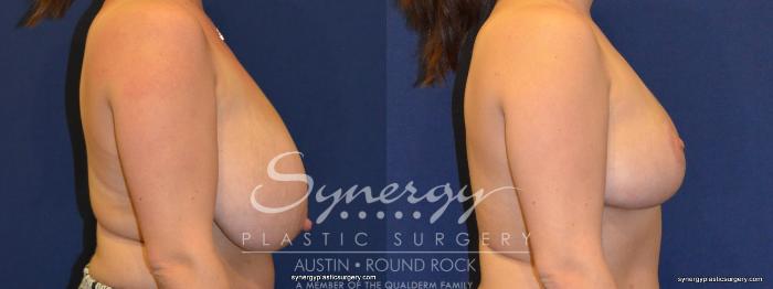Before & After Breast Reduction Case 271 View #4 View in Austin, TX