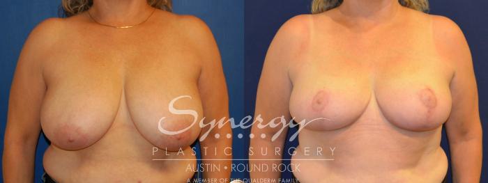 Before & After Breast Reduction Case 289 View #1 View in Austin, TX