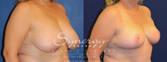 Before & After Breast Reduction Case 289 View #2 View in Austin, TX