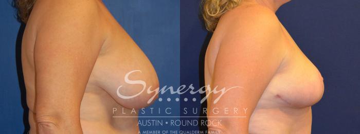 Before & After Breast Reduction Case 289 View #3 View in Austin, TX