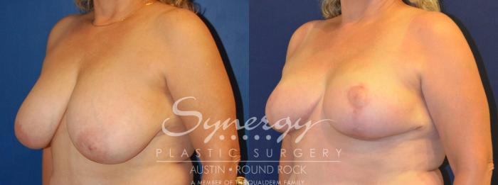 Before & After Breast Reduction Case 289 View #4 View in Austin, TX