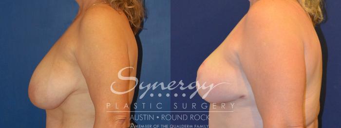 Before & After Breast Reduction Case 289 View #5 View in Austin, TX