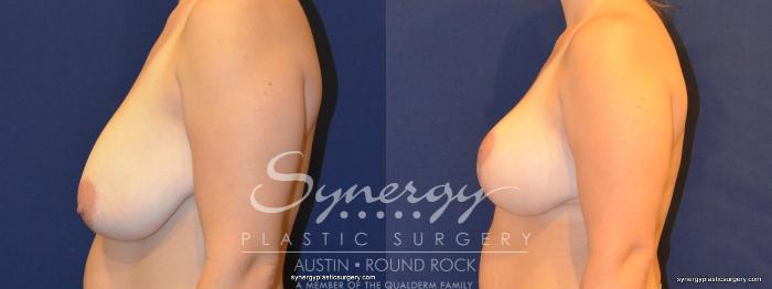 Before & After Breast Reduction Case 324 View #2 View in Austin, TX