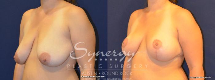 Before & After Breast Reduction Case 324 View #3 View in Austin, TX