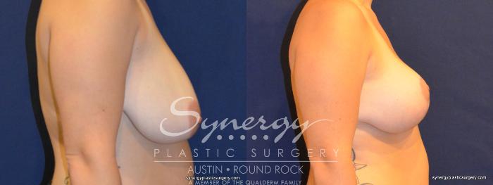 Before & After Breast Reduction Case 324 View #4 View in Austin, TX