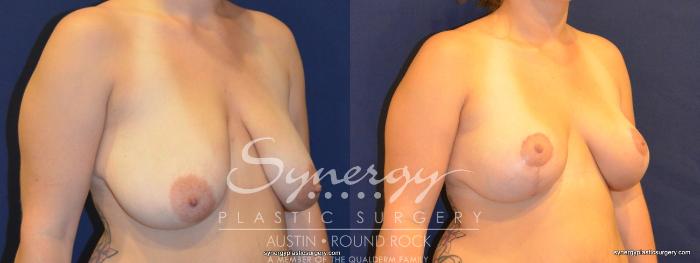 Before & After Breast Reduction Case 324 View #5 View in Austin, TX