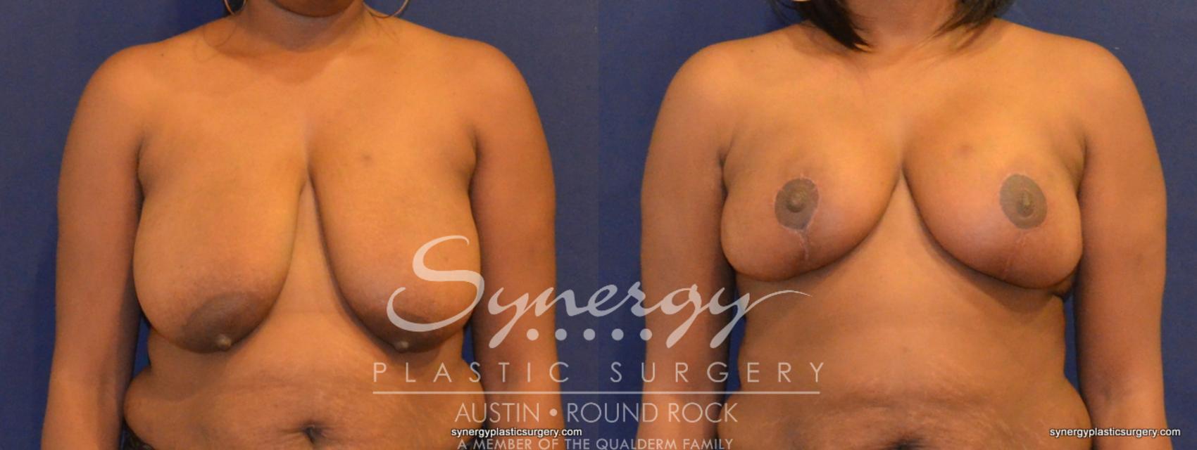 Before & After Breast Reduction Case 349 View #1 View in Austin, TX