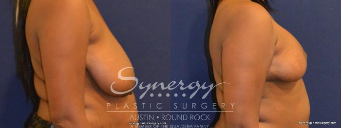 Before & After Breast Reduction Case 349 View #2 View in Austin, TX