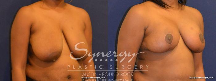 Before & After Breast Reduction Case 349 View #3 View in Austin, TX