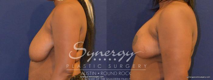 Before & After Breast Reduction Case 349 View #4 View in Austin, TX