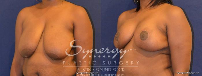 Before & After Breast Reduction Case 349 View #5 View in Austin, TX