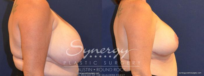 Before & After Breast Reduction Case 363 View #2 View in Austin, TX