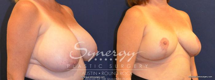 Before & After Breast Reduction Case 363 View #3 View in Austin, TX