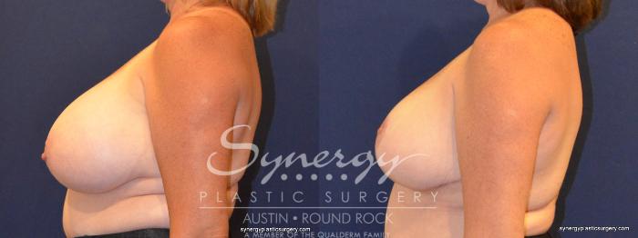 Before & After Breast Reduction Case 363 View #4 View in Austin, TX