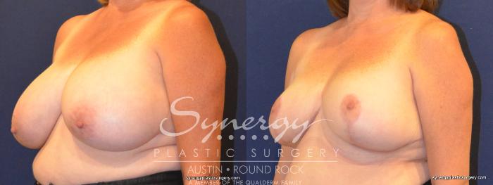 Before & After Breast Reduction Case 363 View #5 View in Austin, TX