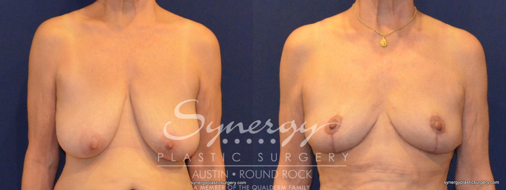Before & After Breast Reduction Case 375 View #1 View in Round Rock, TX