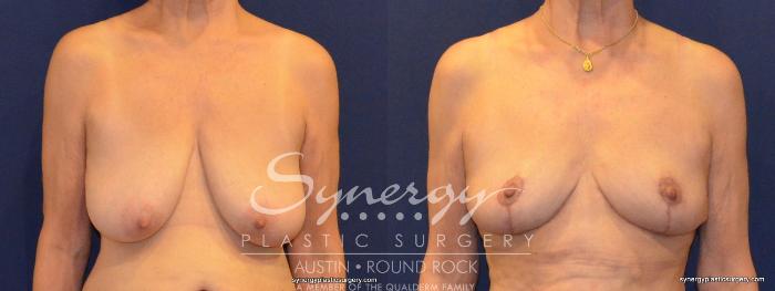 Before & After Breast Reduction Case 375 View #1 View in Austin, TX