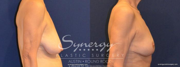 Before & After Breast Reduction Case 375 View #2 View in Austin, TX