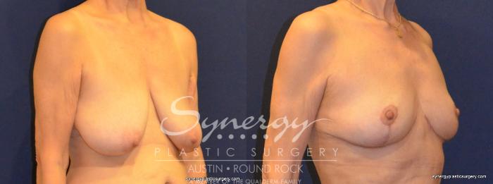 Before & After Breast Reduction Case 375 View #3 View in Austin, TX