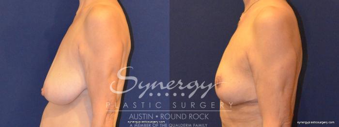 Before & After Breast Reduction Case 375 View #4 View in Austin, TX