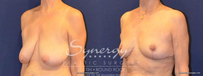 Before & After Breast Reduction Case 375 View #5 View in Austin, TX